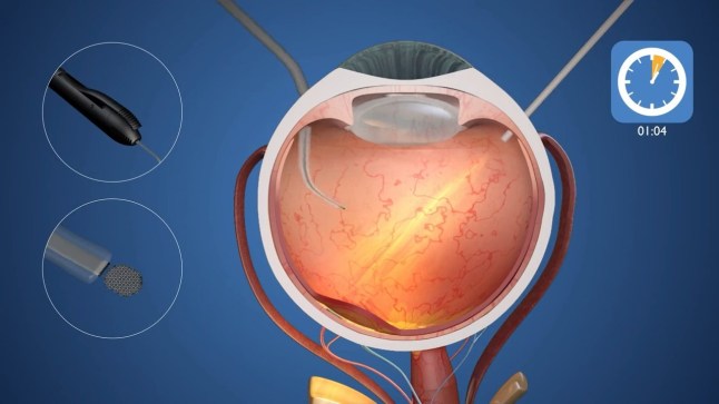 Elon Musk?s competitor creates revolutionary eye chip that restores vision in world's first