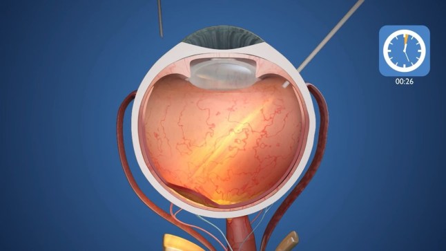 Elon Musk?s competitor creates revolutionary eye chip that restores vision in world's first