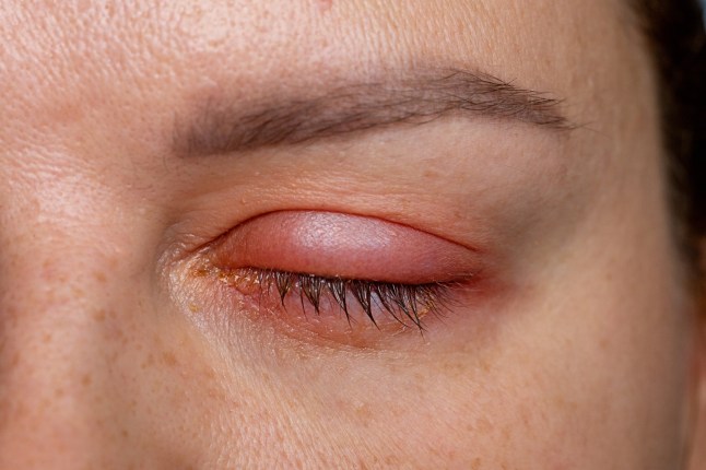 Swelling and redness associated with hordeolum, better known as barley.