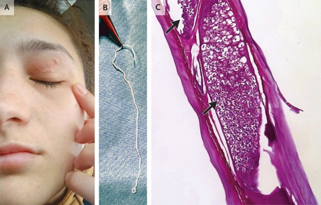 The woman's swollen eye and (centre) the worm after it was removed. Picture: nejm.org