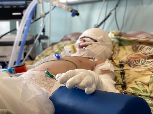 ukraine.ua 115w Roman Oleksiv, 8, undergoes rehabilitation after suffering 45% burns to his body in a Russian missile strike. The boy has to wear a special compression mask to minimise scarring and needs further scar treatment. On July 14, 2022, Russia hit the centre of Vinnytsia. The attack killed 28 people, including Roman?s mother, and injured more than 200. We thank Ukrainian and German doctors for saving the boy's life! Photos: First Lviv Medical Association