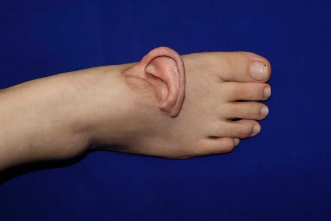 Doctors graft human ear onto foot